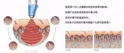 減肥/抗衰兩不誤，BTL溶脂刀儀器一次滿足你