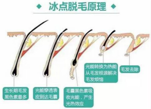 冰點(diǎn)脫毛原理