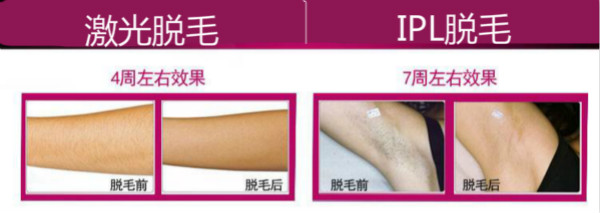 激光脫毛 VS 彩光脫毛 激光脫毛 VS 彩光脫毛