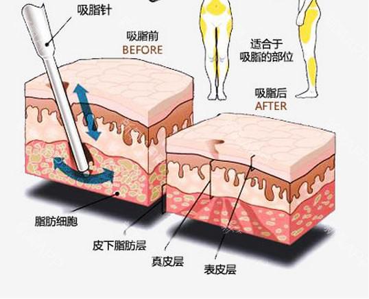 用核磁儀器爆脂減肥？只是一個(gè)噱頭而已
