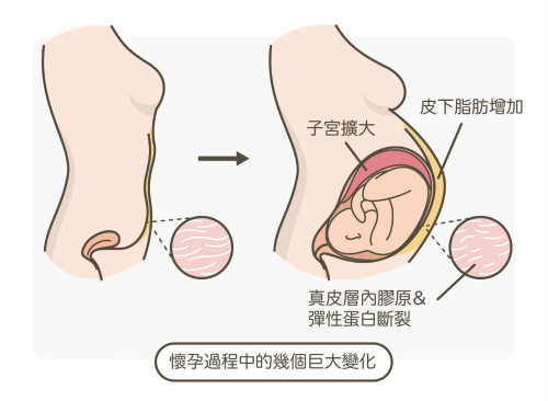 一文秒懂！妊娠紋肥胖紋保養(yǎng)、治療及預防全攻略