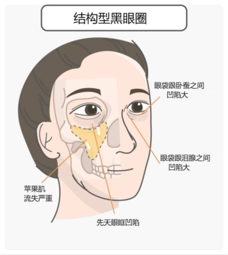 區(qū)分黑眼圈！黑眼圈的成因、分類、預防與治療全攻略