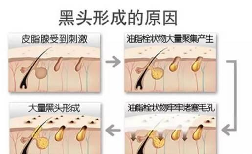 美容儀器廠家教您如何快速祛除黑頭？