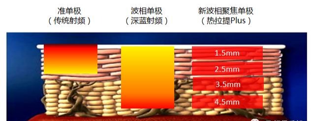 射頻醫(yī)美抗衰發(fā)展史！射頻美容儀到底哪里好？