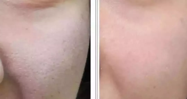 韓國小氣泡丨屬于你的皮膚吸塵器
