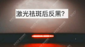 激光祛斑之后皮膚會反黑？美容儀器廠家教你這樣預(yù)防