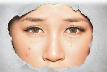 拒當(dāng)「痘花妹」！看痘痘生長(zhǎng)的位置判斷也許是身體出了問(wèn)題