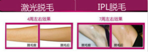 【激光脫毛】風險一定要留意