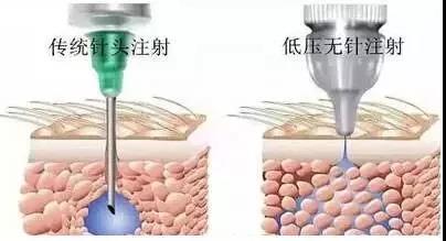 水光針和無針水光到底哪個效果好？