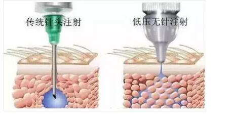 無創(chuàng)水光美容儀可以替代水光針治療嗎？